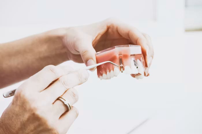 Dental implant model showing tooth replacement