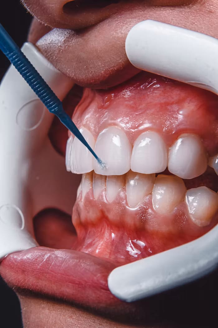 Teeth whitening results close-up