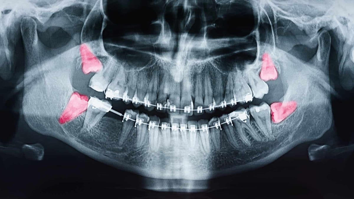 Dental X-ray showing wisdom tooth