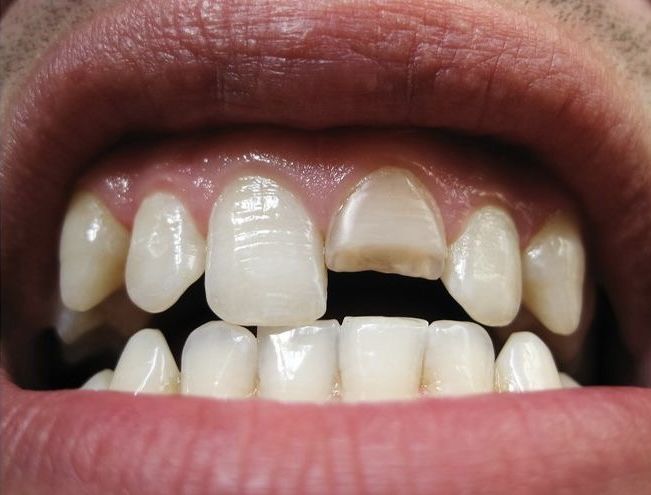 Fracture Management at Brothers Dental, Brahmanbaria