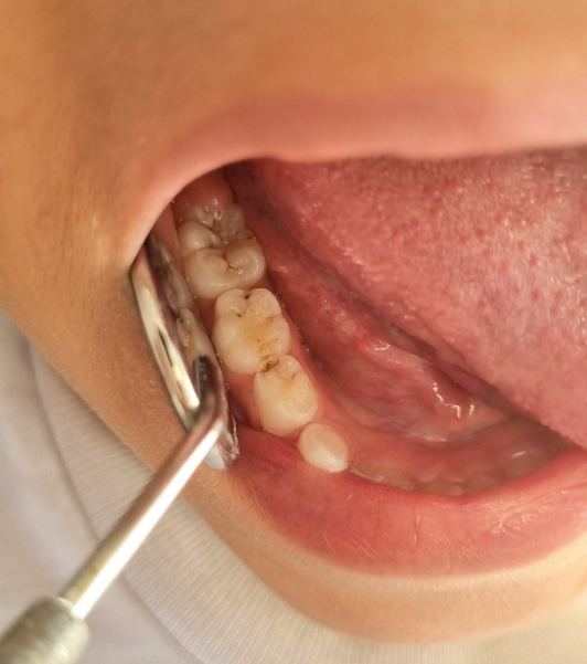 Pulp Capping at Brothers Dental, Brahmanbaria