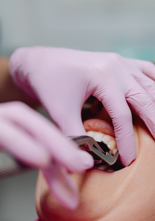 Tooth Extraction at Brothers Dental, Brahmanbaria