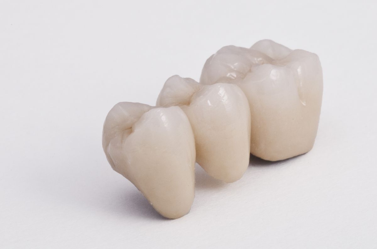 Dental Bridge at Brothers Dental, Brahmanbaria