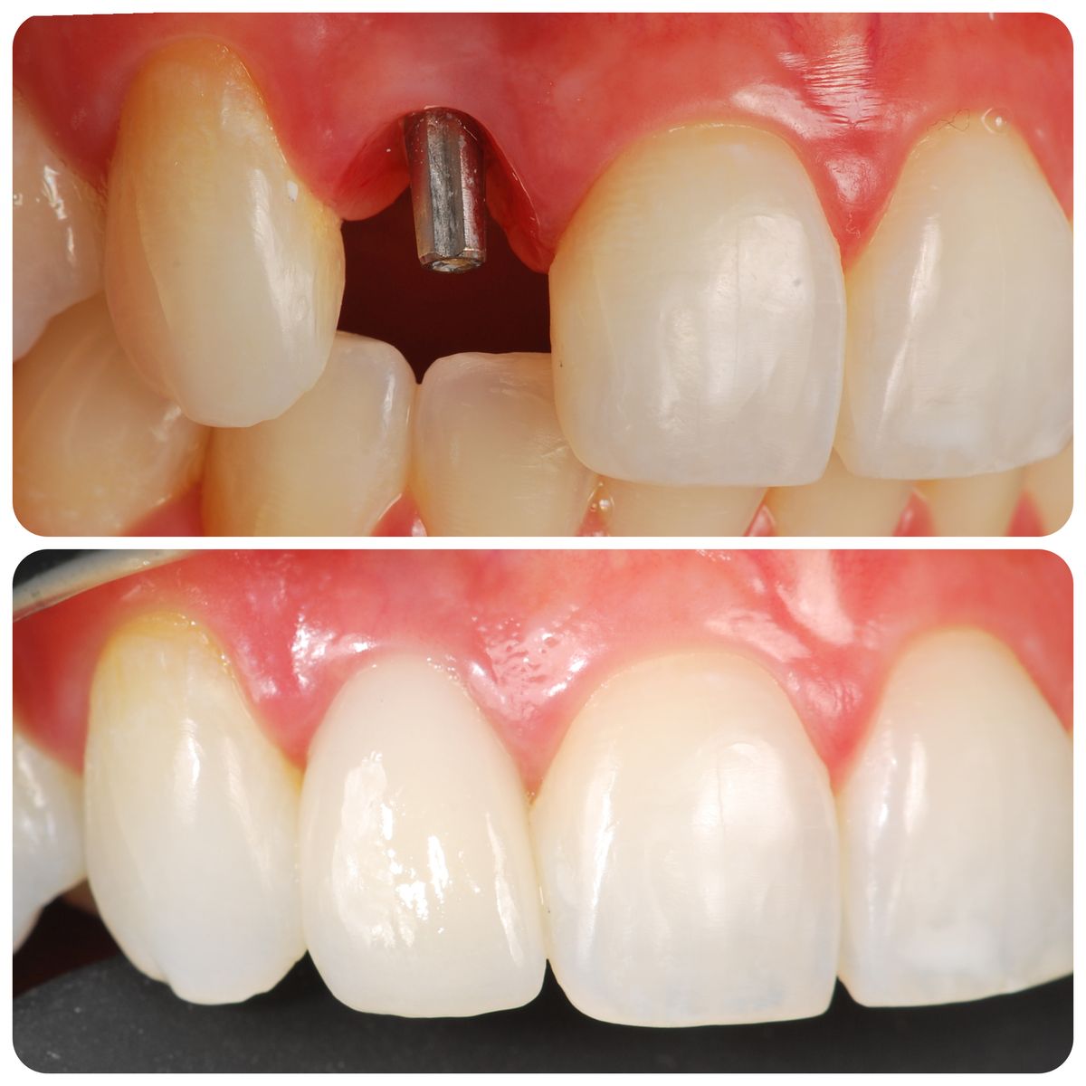 Restoration dentistry at Brothers Dental