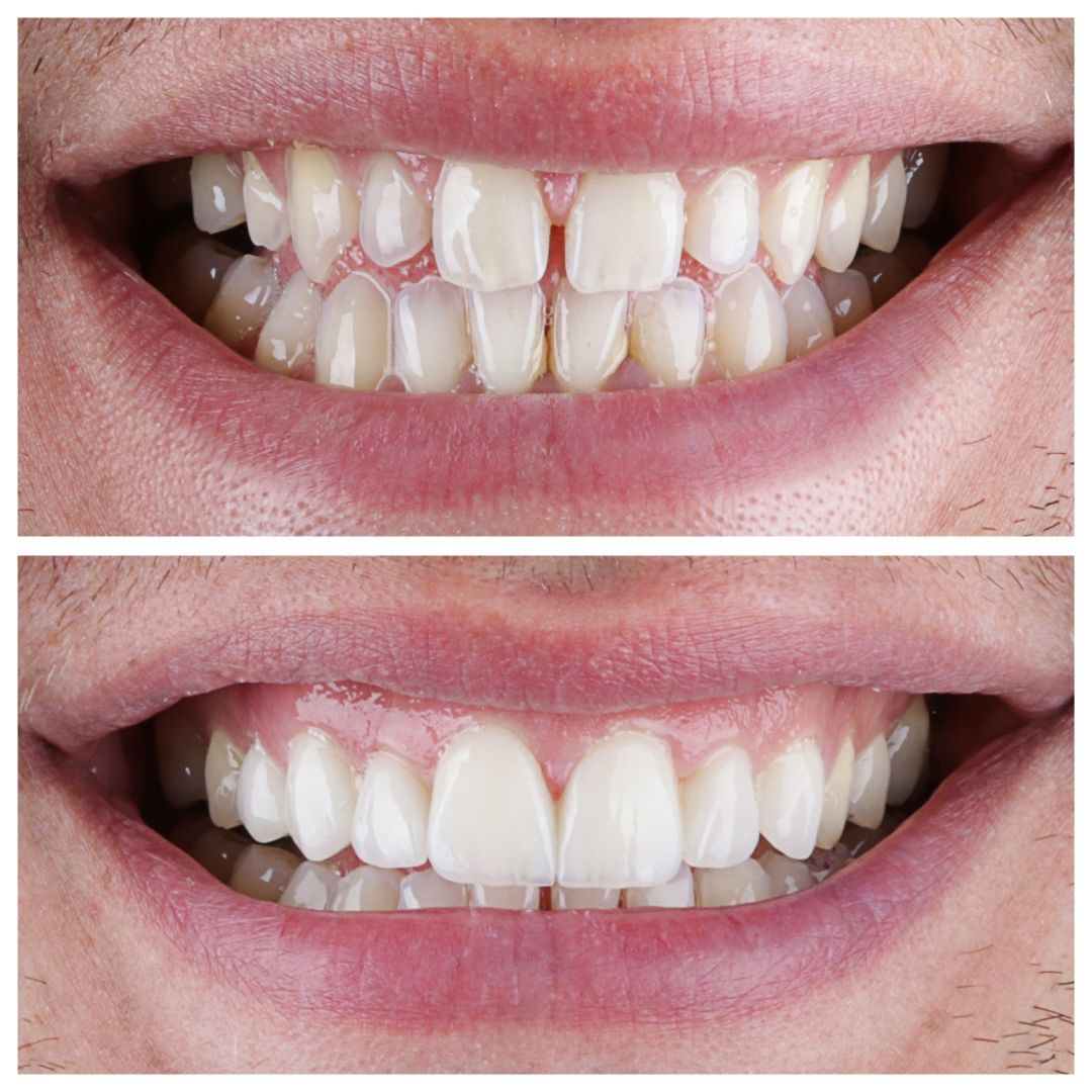 Cosmetic Filling at Brothers Dental, Brahmanbaria