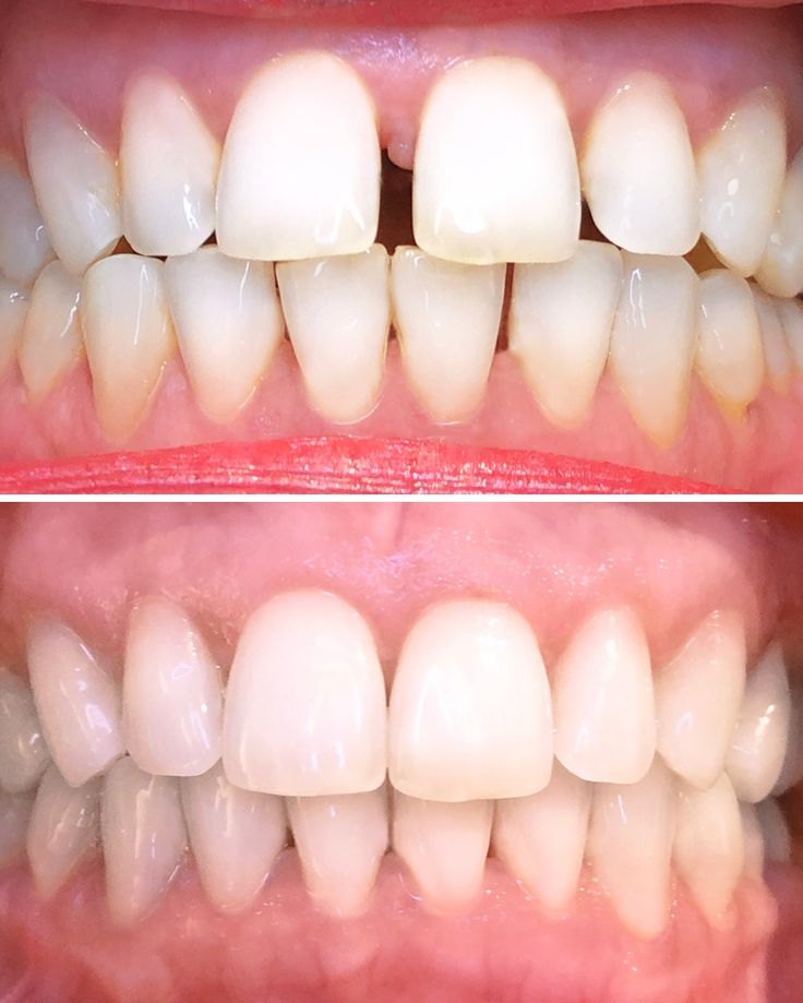 Front Teeth Gap Closure at Brothers Dental, Brahmanbaria