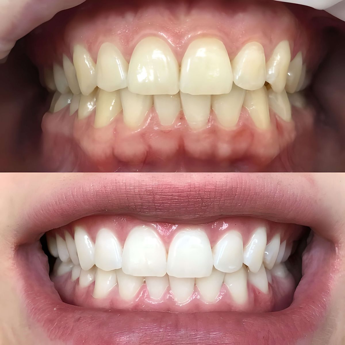 Tooth Whitening at Brothers Dental, Brahmanbaria