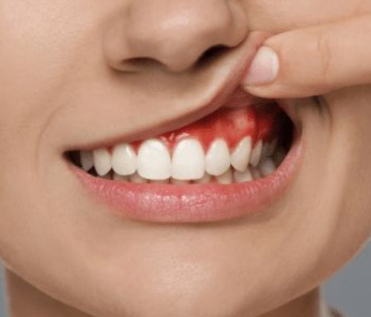 Dental / Gingival Surgery at Brothers Dental, Brahmanbaria