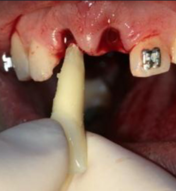 Tooth Avulsion Management at Brothers Dental, Brahmanbaria